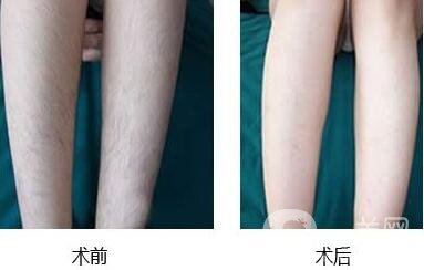 激光脫毛,價格