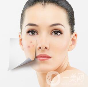 像素激光調(diào)節(jié)痘坑*果怎么樣？