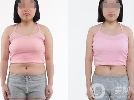 超聲波抽脂價(jià)格多少？超聲波抽脂有什么優(yōu)點(diǎn)？