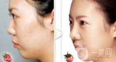 正規(guī)醫(yī)院做果酸換膚要多少錢？