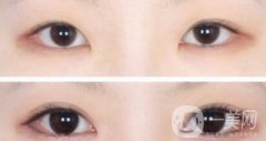 開(kāi)眼角手術(shù)醫(yī)院介紹？開(kāi)眼角哪好？