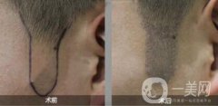 正規(guī)的醫(yī)院做植鬢角手術多少錢
