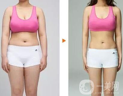 鐳射溶脂價(jià)格要多少錢？