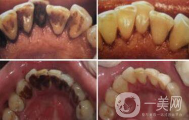 *潔牙好不好？*果可以維持幾年？