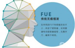 什么是fue植發(fā)，fue植發(fā)技術(shù)果怎么樣？