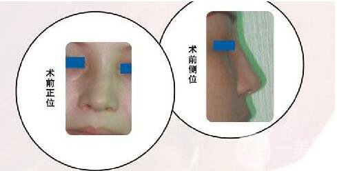 歪鼻矯正,多少錢(qián)