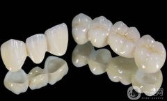 鈷鉻烤瓷牙好不好？可以保持多久？