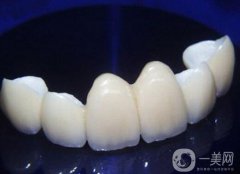 貴金屬烤瓷牙和全瓷牙信息介紹？