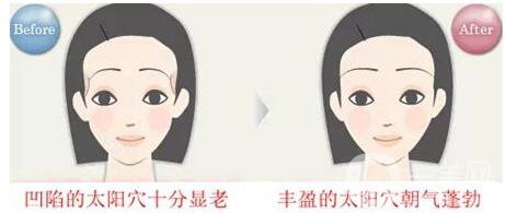 豐太陽(yáng)穴,價(jià)格