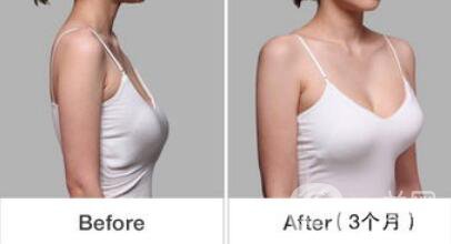 乳房下垂松軟怎么辦？可以做手術矯正嗎？