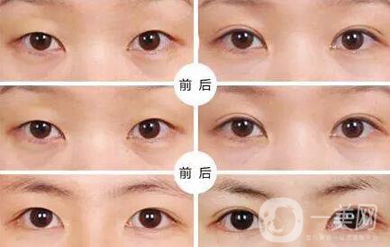 不開(kāi)刀的雙眼皮*果是*的嗎