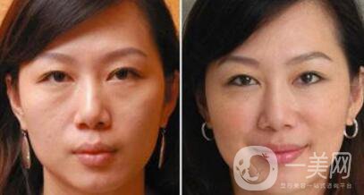 塑美極*果怎么樣？塑美極要做多少次？