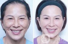 塑美極果怎么樣？塑美極要做多少次？