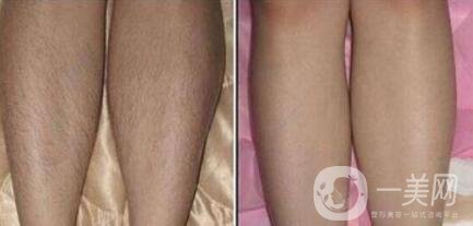 怎么去腿毛？*脫腿毛的方式是什么？