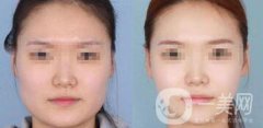 怎樣變瓜子臉？磨骨整形還是*？