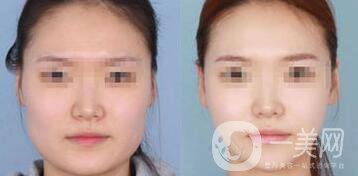 怎樣變瓜子臉？磨骨整形還是*？