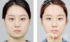 怎樣變瓜子臉？可以打*嗎？