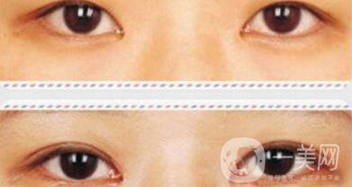開眼角術(shù)后要眼角增生自己會(huì)消失嗎
