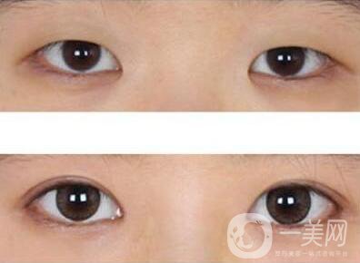 開眼角術(shù)后要眼角增生自己會(huì)消失嗎