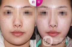 雙下巴怎么減才快速*？去雙下巴方法介紹