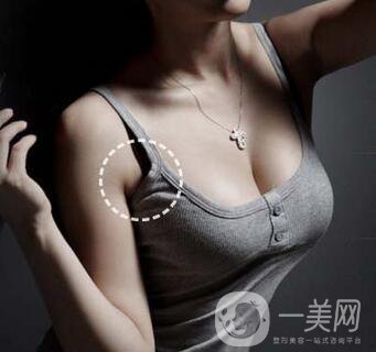副乳切除術(shù)創(chuàng)口多大？