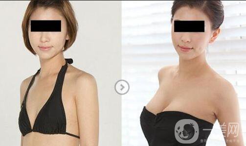 假體隆胸手術(shù)做完之后恢復(fù)期要多久時(shí)間？