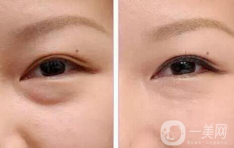 超聲波去眼袋好嗎，有哪些優(yōu)點(diǎn)？