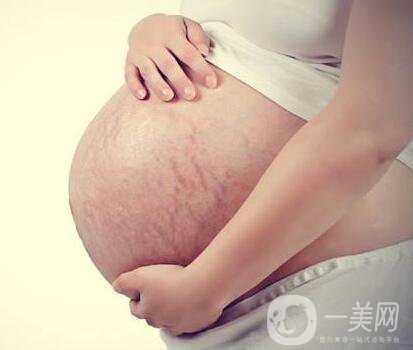 有妊娠紋怎么辦？什么方法**？