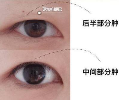 眼部抽脂前后，*果*看過來！