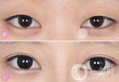 眼部手術(shù)都包含哪些項(xiàng)目？眼部手術(shù)整形多少錢