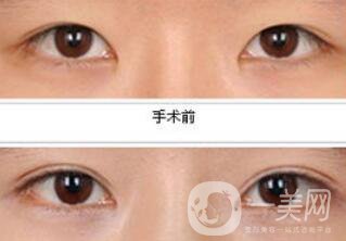 *都包含哪些項(xiàng)目？*整形多少錢