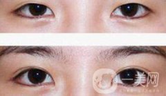 埋線雙眼皮多久消腫？幾天可以恢復(fù)自然