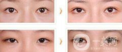 全切雙眼皮術(shù)后吃什么？術(shù)后如何護(hù)理