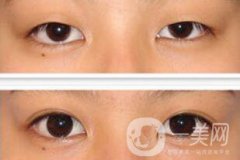 全切雙眼皮術(shù)后怎么護(hù)理？需要注意什么