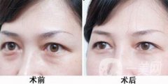 激光去眼袋的副作用 需要如何處理