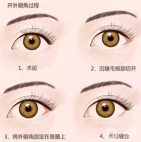 開(kāi)眼角*果怎么樣？手術(shù)風(fēng)險(xiǎn)大不大