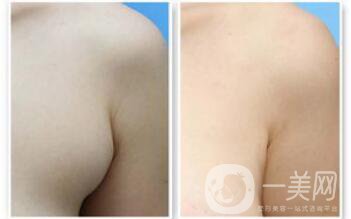 副乳是什么？副乳切除手術(shù)需要多久
