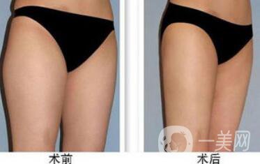 大腿吸脂多久恢復(fù)？大腿吸脂后遺癥有哪些