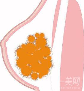 取出乳房奧美定*果怎么樣？取出*嗎？
