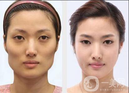磨顴骨手術(shù)之后容易有后遺癥么？主要有哪些情況？