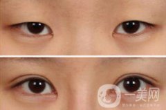 雙眼皮手術(shù)有哪些方法？做雙眼皮前要準(zhǔn)備什么