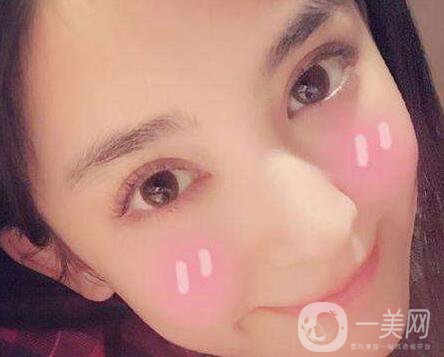 做了雙眼皮增生怎么辦？