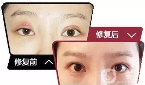 雙眼皮增生是什么樣子？