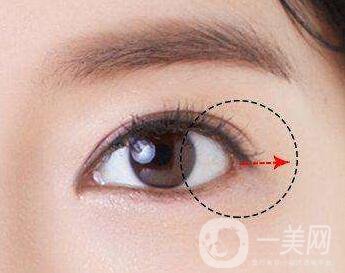 開眼角需要注意些什么？
