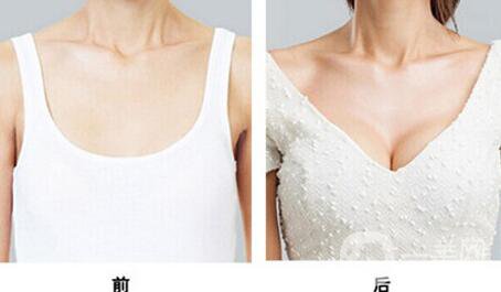 假體隆胸多久開始按摩？具體如何操作
