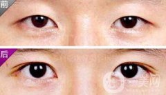 埋線雙眼皮之后禁忌有哪些？具體注意事項介紹