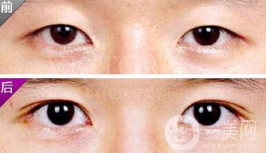 埋線雙眼皮之后禁忌有哪些？具體注意事項(xiàng)介紹