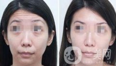抬頭紋能消除嗎？用什么方法祛除抬頭紋