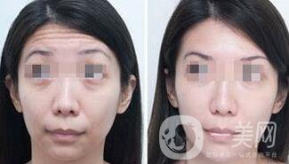 抬頭紋能消除嗎？用什么方法祛除抬頭紋