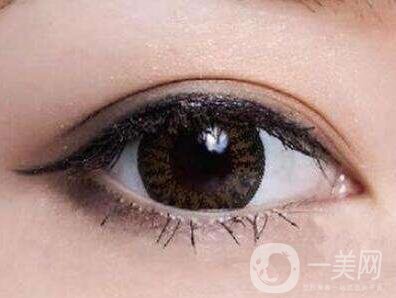 埋線雙眼皮要拆線嗎？如何護(hù)理？
